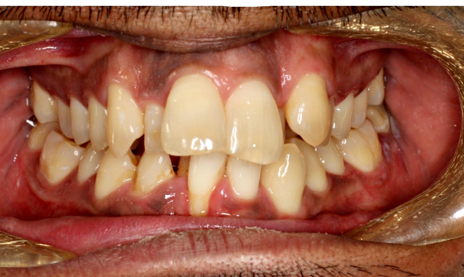 Crooked Teeth Rix Orthodontics Calgary Ab